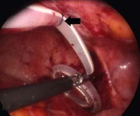 Part 1: Mechanical Potential complications of laparoscopic suture sling Suture sling too tight and crimps tubing with flow obstruction Patient may experience persistent pinching pain at sling site if