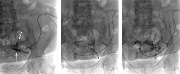Part 1: Mechanical Fluoroscopic guidewire manipulation to disrupt extraluminal obstruction Fluoroscopic rescue procedure for tissue attachment Contrast study shows contrast material stasis (arrows)