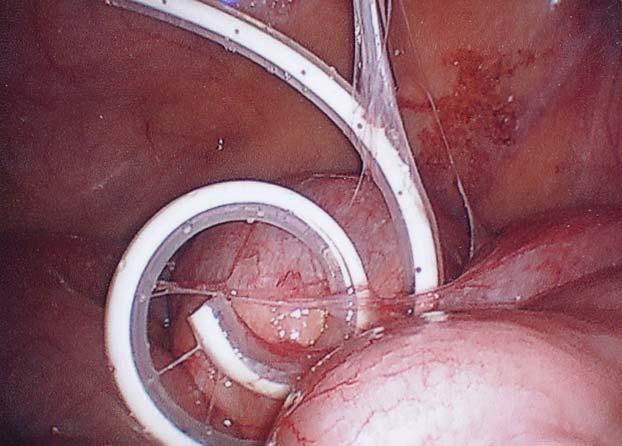 Part 1: Mechanical Flow obstruction from adhesions Catheter entrapped between loops of bowel by adhesions Slide 42 Adhesions are a form of scar tissue that may result from inflammation and irritation