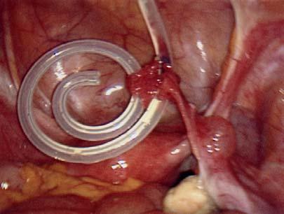 Part 1: Mechanical Flow obstruction from uterine tube Uterine tube obstructing proximal side holes of catheter Slide 43 The fimbria of the uterine tubes is another tissue structure that can siphon up
