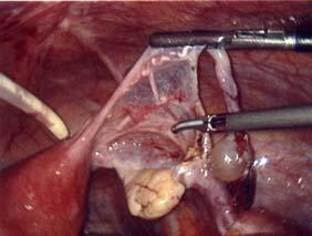 Part 1: Mechanical Management of flow obstruction from uterine tube Laparoscopic salpingectomy Uterine Tube Uterine Tube Uterus Ovary Uterus Ovary Uterine tube obstruction of catheter tip