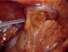 the colon. They are particularly predominant in the rectosigmoid region where the PD catheter tip usually comes to rest.