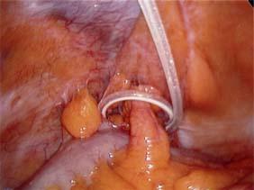 Part 1: Mechanical Management of epiploic appendix obstruction Obstruction of catheter tip by epiploic appendix of sigmoid