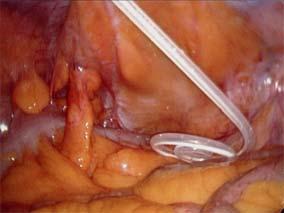 obstruction of the catheter tip by an epiploic appendix of the sigmoid colon.