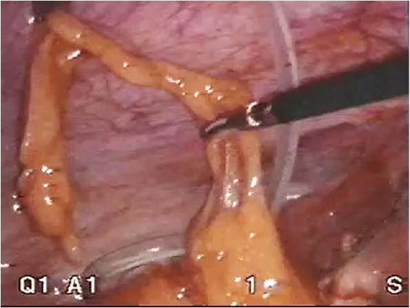 Part 1: Mechanical Alternatively, epiploic appendices can be resected Laparoscopic resection of epiploic appendix Slide 47 Other