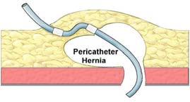 Part 1: Mechanical Late pericatheter leak from pericatheter hernia Key assessments Midline insertion of catheter predisposes to pericatheter hernia Contributing factors include abdominal wall