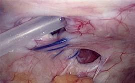 catheter extrusion, catheter-tip malposition, and visceral incarceration Head Hernia Defects Pelvis Diaz-Buxo. of peritoneal dialysis catheters: early and late. Int J Artif Organs 2006; 29:50-8.