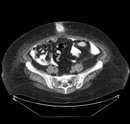 Part 1: Mechanical CT Peritoneography for occult umbilical hernia Small umbilical defect with radiocontrast extravasated into periumbilical tissues PD Catheter PD Catheter in rectus sheath Note