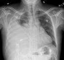 Part 1: Mechanical Thoracoscopic pleurodesis with talc poudrage Key activities Interim hemodialysis will be required Thoracoscopic approach is minimally invasive Pleurodesis: roughing up the pleural