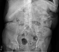 Part 1: Mechanical Mechanical catheter flow dysfunction from stoolfilled bowel Extrinsic compression