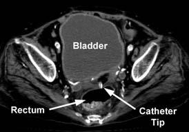 Part 1: Mechanical Mechanical catheter flow dysfunction from bladder distention Extrinsic compression of catheter tip (variable inflow-outflow) CT scan
