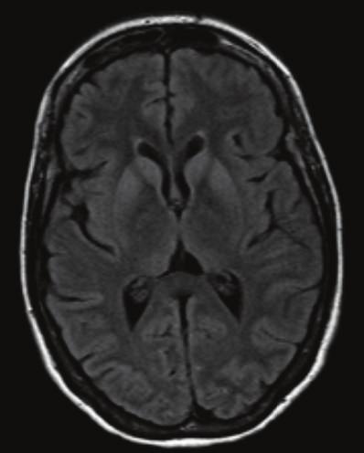Case Reports in Neurological Medicine 3 (a) (b) (c) Figure 2: MRI findings (axial FLAIR, T2, and DWI).