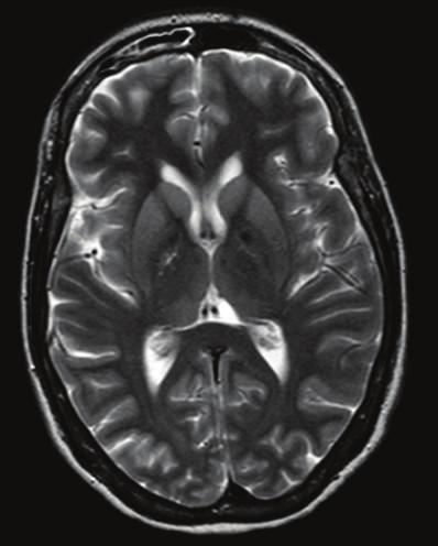 with diffuse grey matter involvement, including anoxia, CNS infection (Herpes Simplex encephalitis), autoimmune encephalopathy, autoimmune thyroiditis, hepatic and renal disease, drugs/toxins,