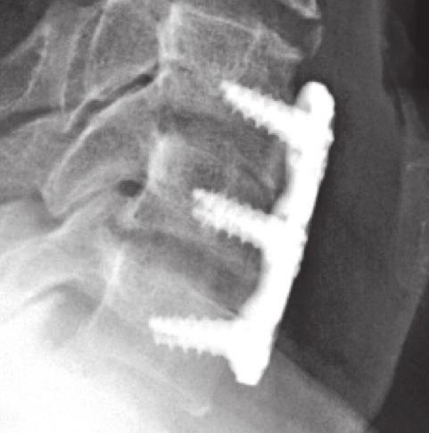 Original research Dynamic anterior cervical plating for multi-level spondylosis: Does it help? 43 tacted individually and interviewed via telephone and asked to obtain one last x-ray.