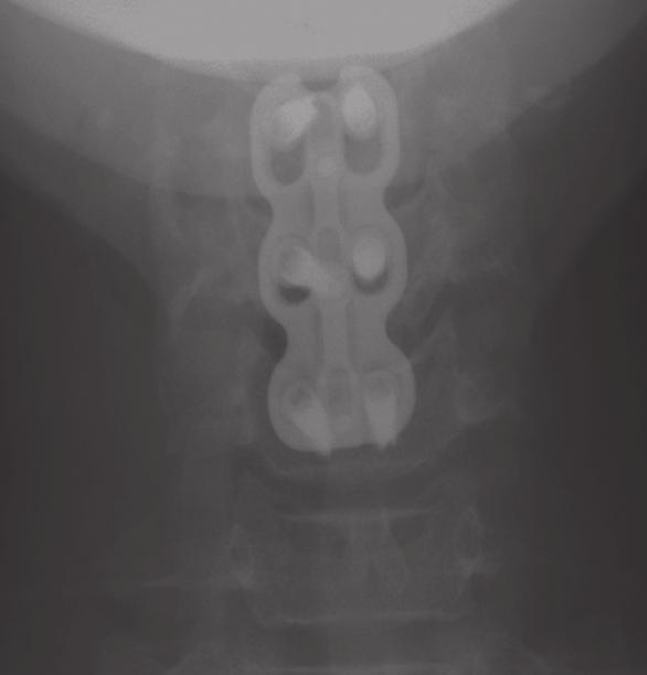 Original research Dynamic anterior cervical plating for multi-level spondylosis: Does it help?