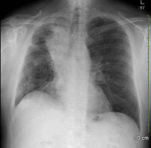 Sudden Onset Dyspnea 57 year old male presents to Emergency Department Dec/1 st /06 sudden onset of shortness of breath after a coughing