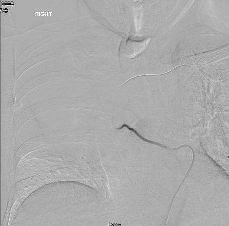 requested Embolization of the feeding bronchial arteries to