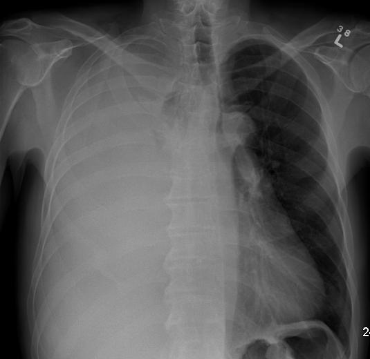 White-out of a hemithorax 70 y.