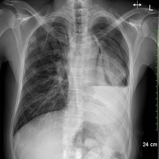 Pleural Physiology Un expandable lung (40%) Endobronchial Obstruction Severe
