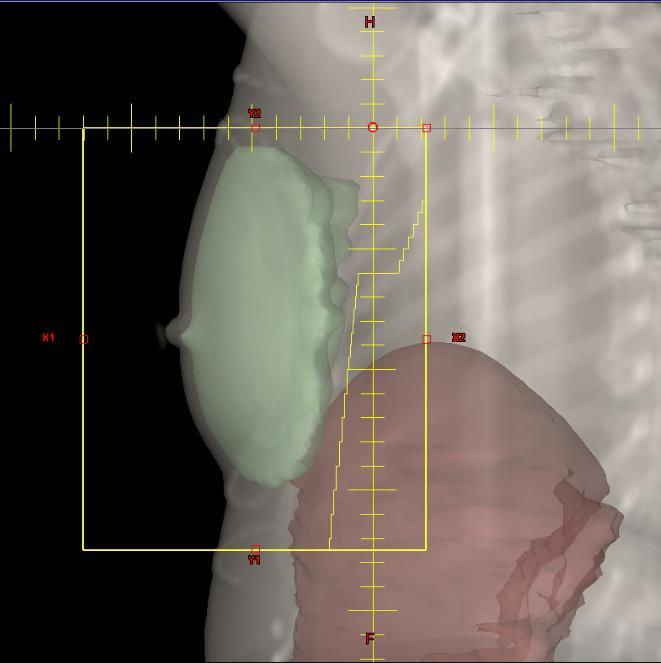 (left) and BH scan (right) for patient 6.