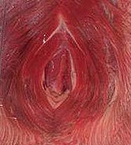 Test Format The image shown represents which vulvar condition?