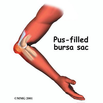 activities or job can repeatedly injure the bursa. This repeated injury can lead to irritation and thickening of the bursa over time.