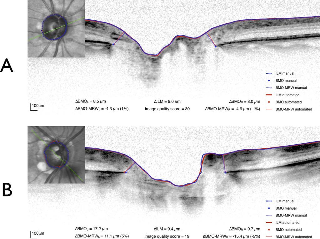 Segmentation of Optic Nerve Head Structures IOVS j February 2014 j Vol. 55 j No. 2 j 1165 FIGURE 6.