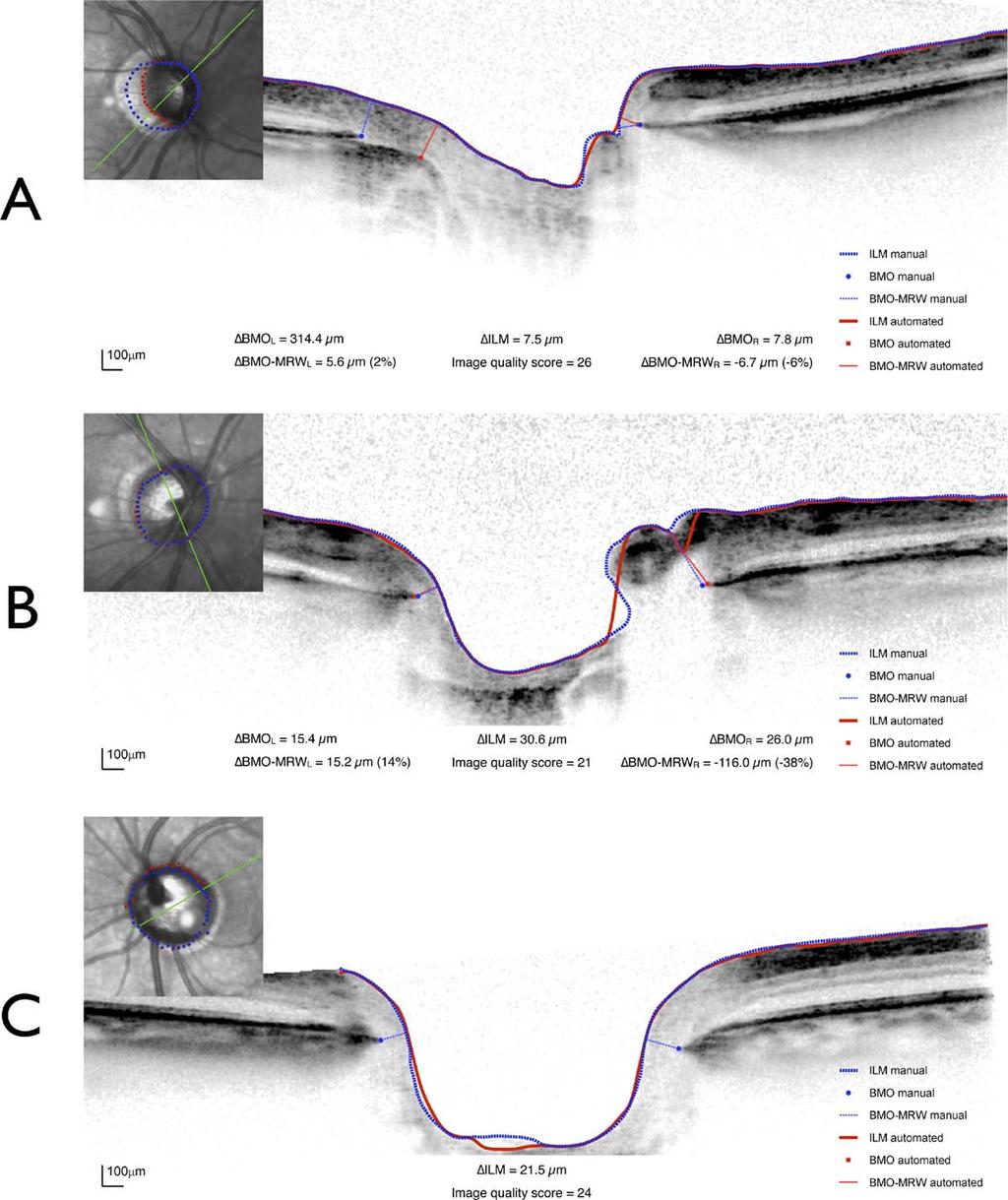 Segmentation of Optic Nerve Head Structures IOVS j February 2014 j Vol. 55 j No. 2 j 1166 FIGURE 7.