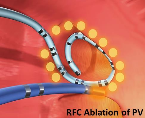 RFC Ablation ( FIRE ) vs Cryoballoon Ablation ( ICE )