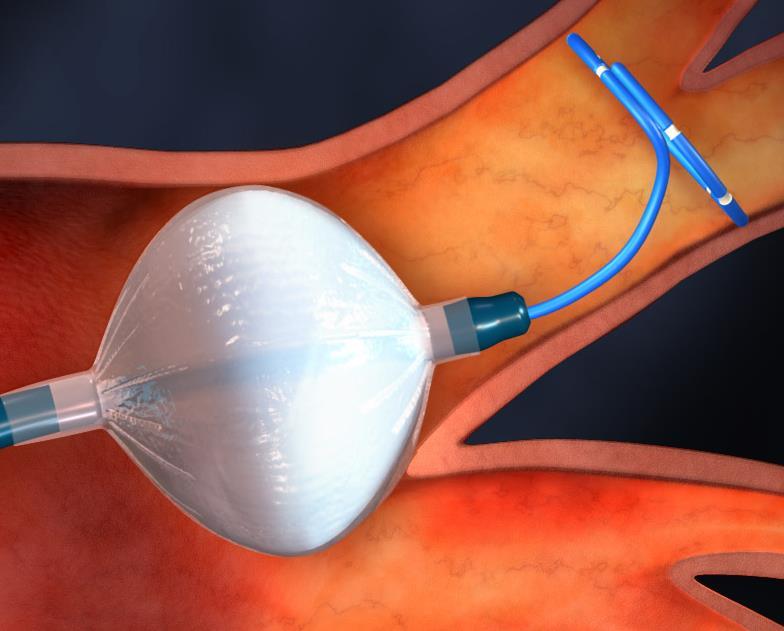 Cryoballoon or Radiofrequency Ablation of Paroxysmal Atrial