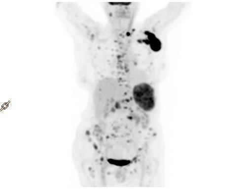 Lymphoma Common radiographic features of lymphoma Homogeneous lymph node lesions Continuous or scattered whole body distribution of nodal lesions.