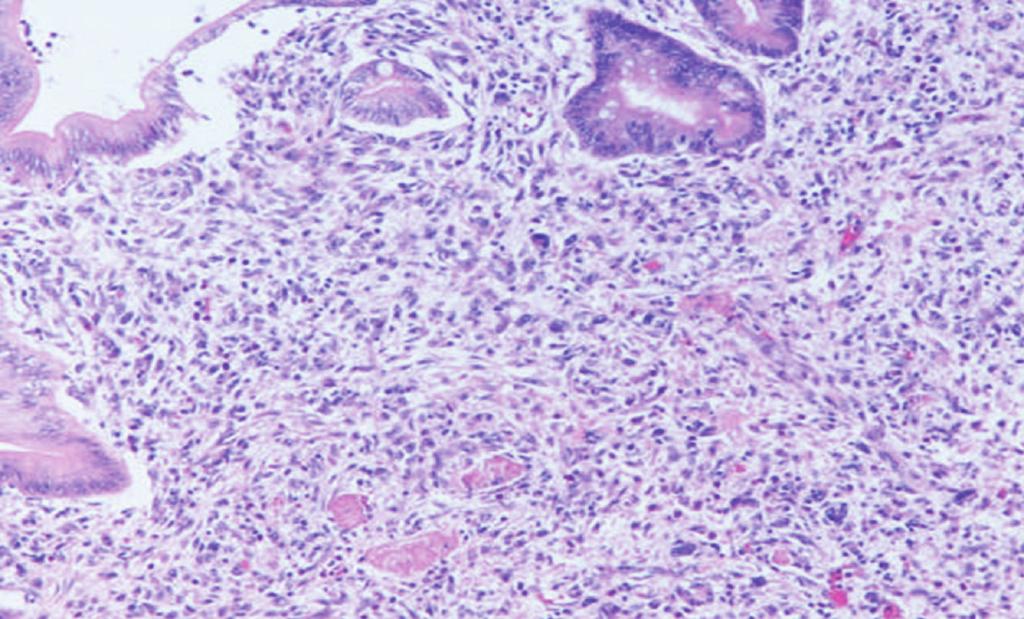 liposarcoma at the small bowel resection margins.