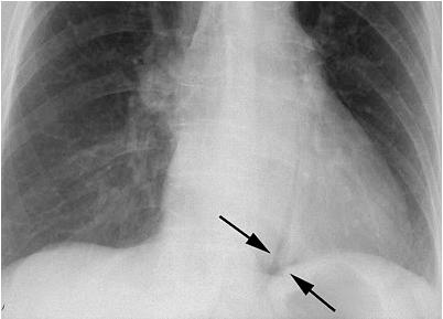 DIAGNOSIS - PLAIN FILMS Lateral Neck, CXR Suggestive in 90% of esoph perfs CAVEAT: timing May be normal up to 1 hour after event Mediastinal Air