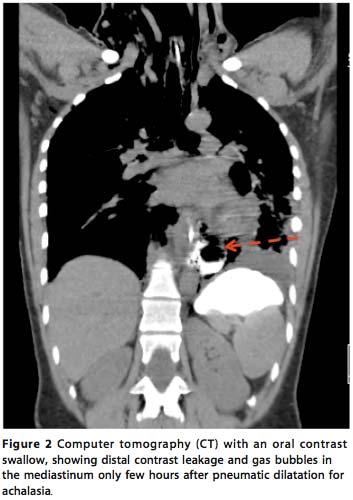 DIAGNOSIS - CT Most-common finding: extraluminal air Useful in