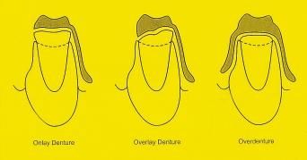 Figure 1. Worn dentition and denture designs. overdenture may be further improved by incorporation of magnets, precision attachments on natural roots or implants.