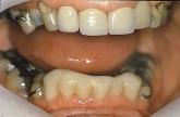 Case 2: prepared lower anterior teeth after core build-up using a cermet cement. occlusal splint.