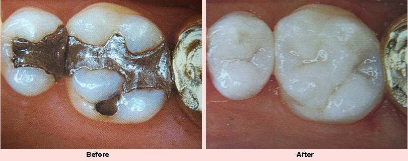 Fillings Dental decay occurs due to improper brushing leading to incomplete removal of food stuck in between teeth.