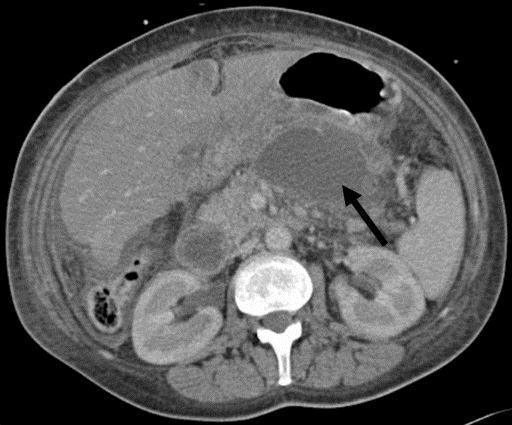 Figure 3: CECT Showing Pancreatic necrosis with pseudocyst DISCUSSION Acute pancreatitis is a common disease entity and its frequent occurrence with its serious complications have brought into issues