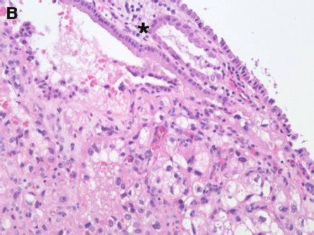 colon cancer, an intramucosal metastasis of a clear cell renal cell carcinoma was found in the gallbladder (Figure3).