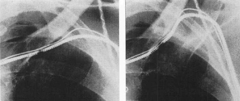 ICD Leads: No Subclavian Puncture! 1.