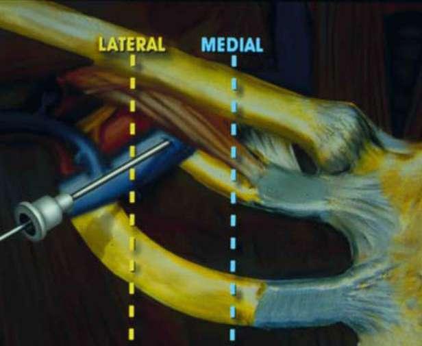 Calcified ligaments crush the lead when sheath is