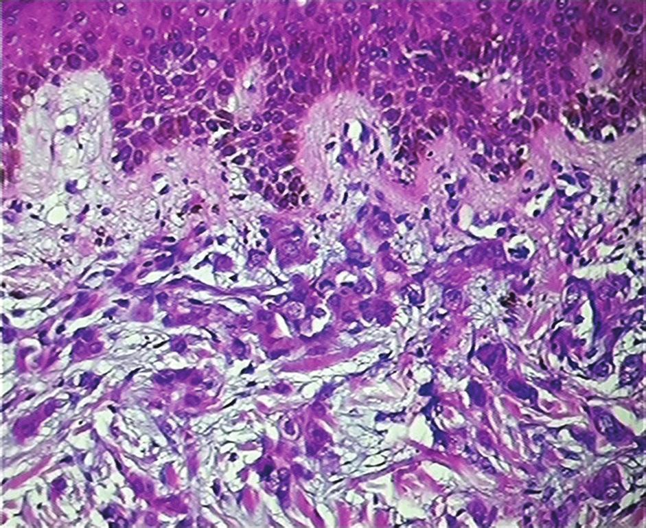 2 Figure 1: Sections show deposits of metastatic breast carcinoma (H&E 100).