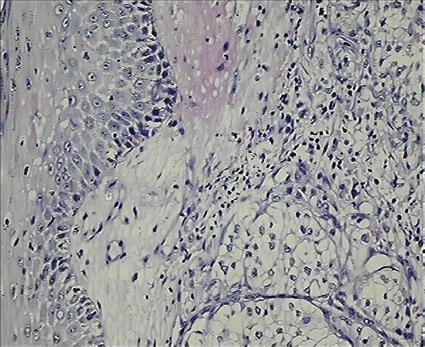 Immunohistochemistry was performed on all except for one case of cutaneous metastases and correlation with the primary internal malignancy was done. 3.