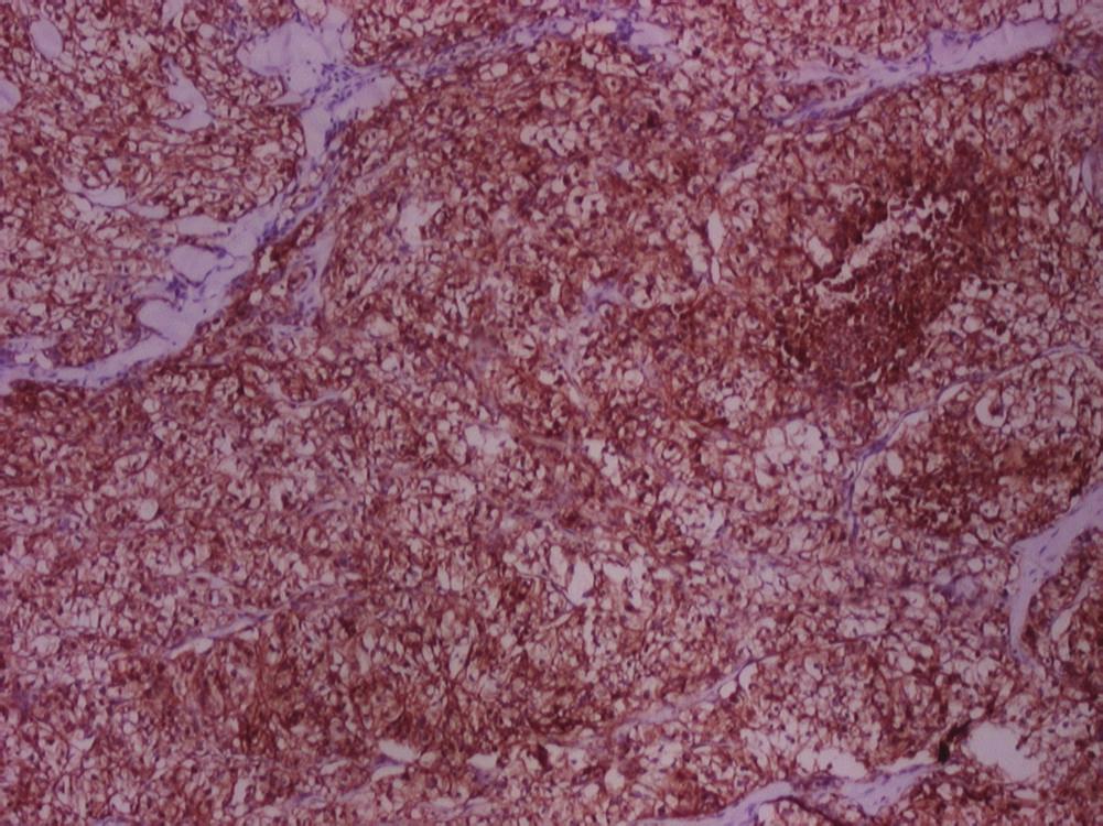The cutaneous metastases were seen more in females (5 out of 9 patients). The four male patients had skin metastases from renal cell carcinoma and from nonhodgkin lymphoma (2 cases each).