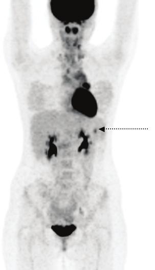combined PET/CT clearly demonstrates that FDG uptake here is due to a lymph node adjacent to greater curve of stomach.