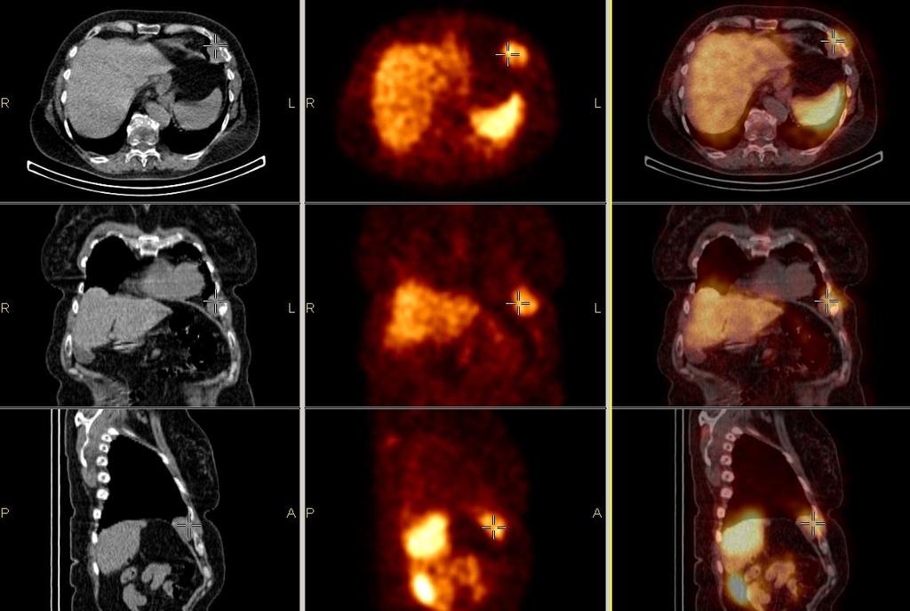 Carcinoid metastasis in chest