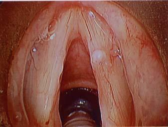 type 1 or type 2 cordectomy according the European classification system had similar voice outcome
