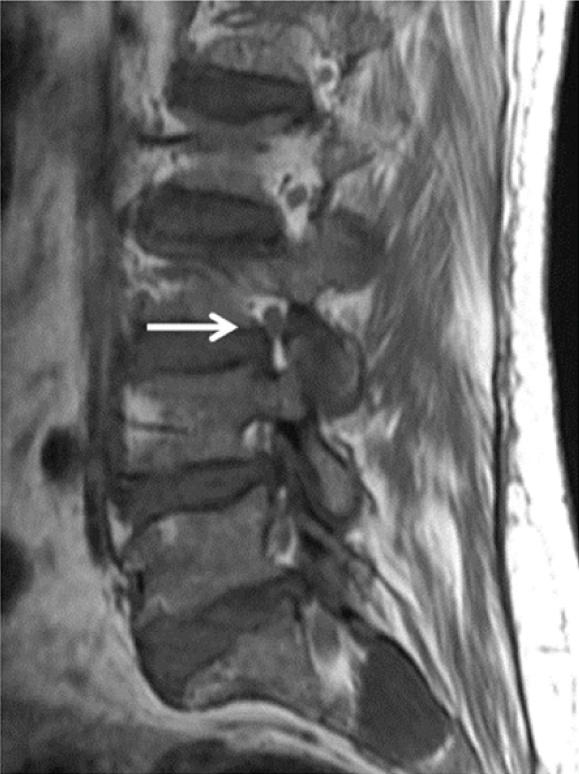 Note the nerve root abutting the bulging disc and ligamentum flavum with effacement of perineural fat on two sides. [Table/Fig-6]: (Right) 3 neural foramen stenosis.