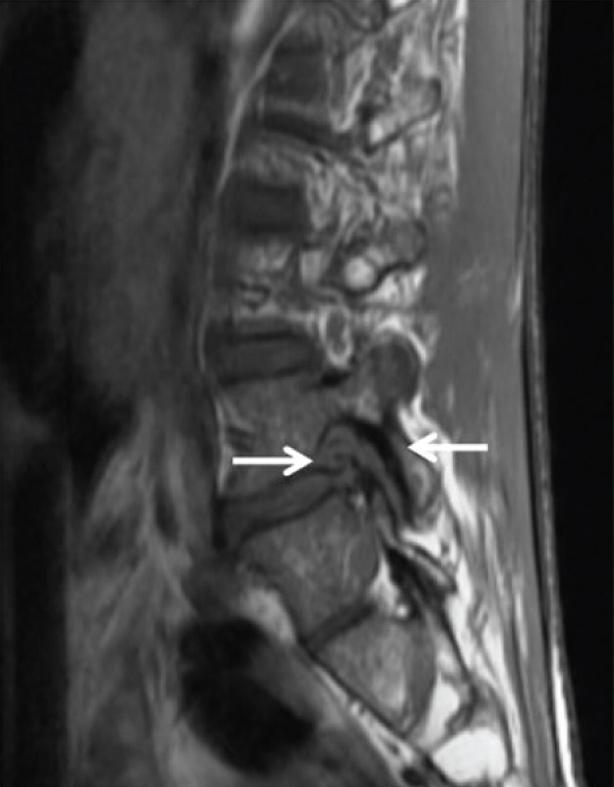 Note the bulging disc, osteophyte and ligamentum flavum hypertrophy causing complete effacement of perineural fat. [Table/Fig-7]: 3-neural foramen stenosis.