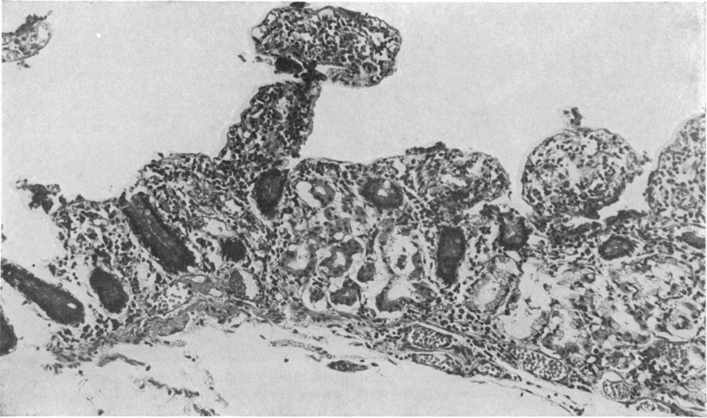 Fig. 4 True gastric metaplasia in a patient with Crohn's disease ofthe ileum.